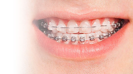 Ceramic braces