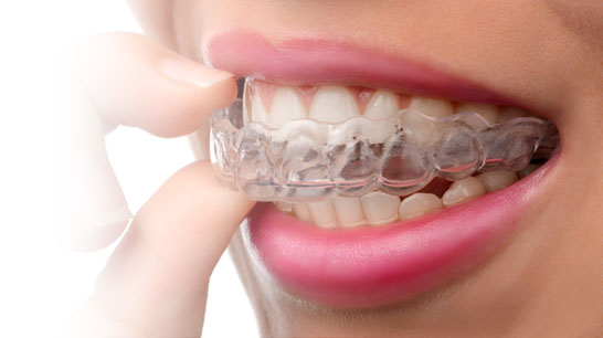 Invisalign braces