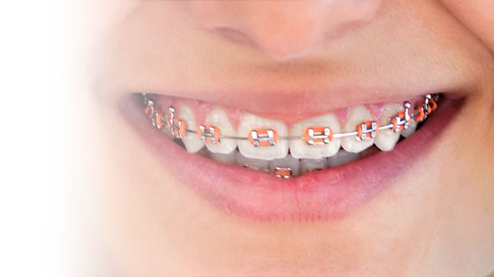 Traditional metal braces